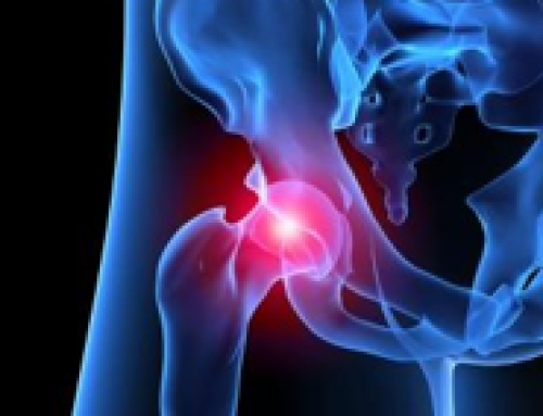 All About Hip Arthritis from a Beverly Hills Orthopedic