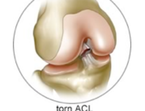 ACL Reconstruction Basics Treatment By Knee Specialist Los Angeles